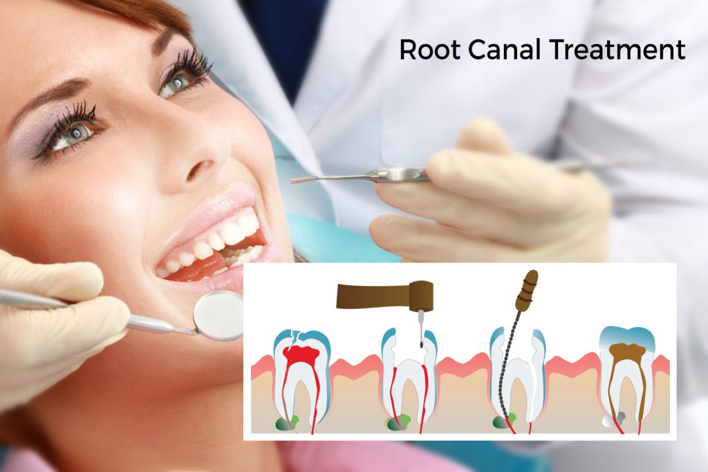 root canal treatment