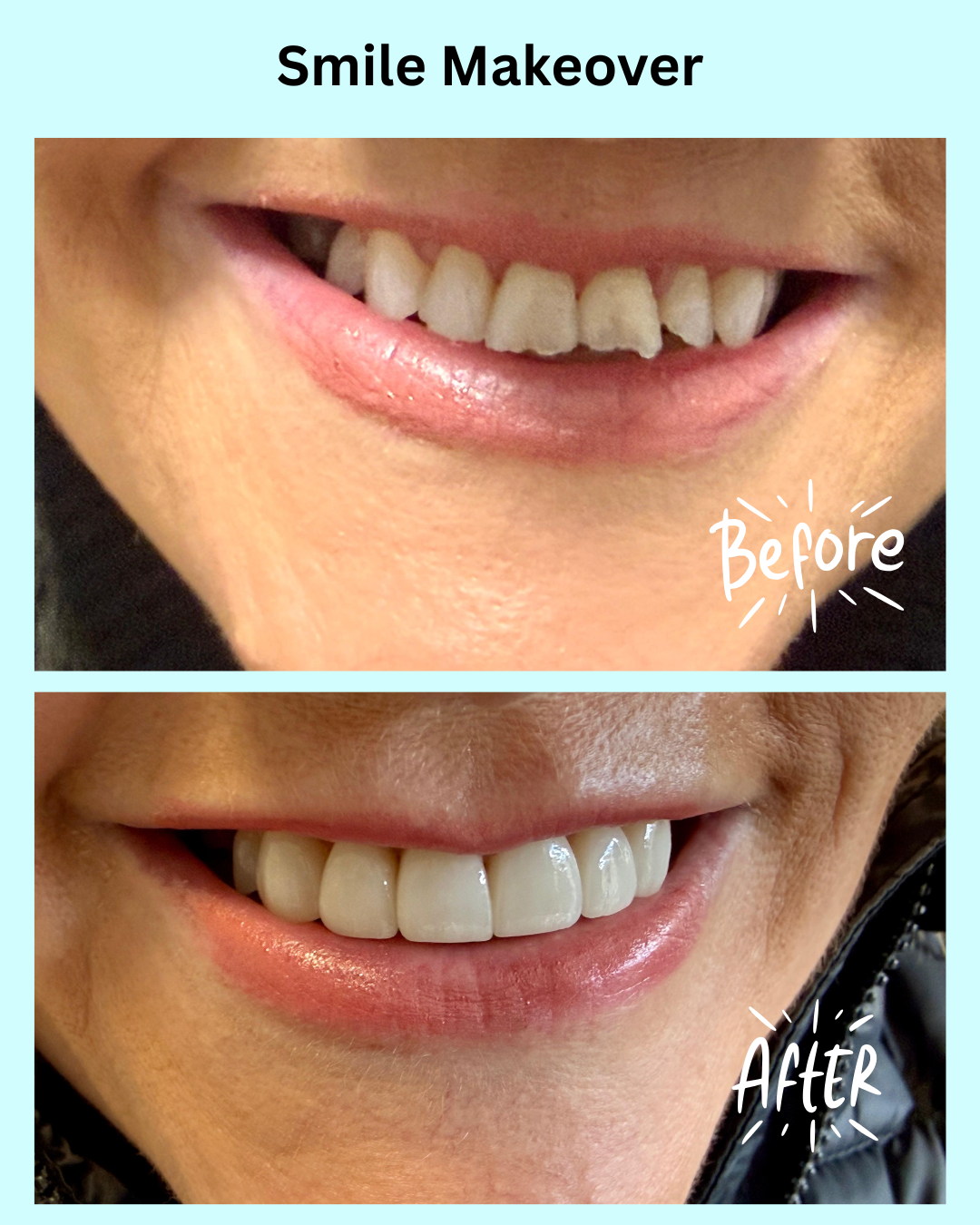 Smile Makeover