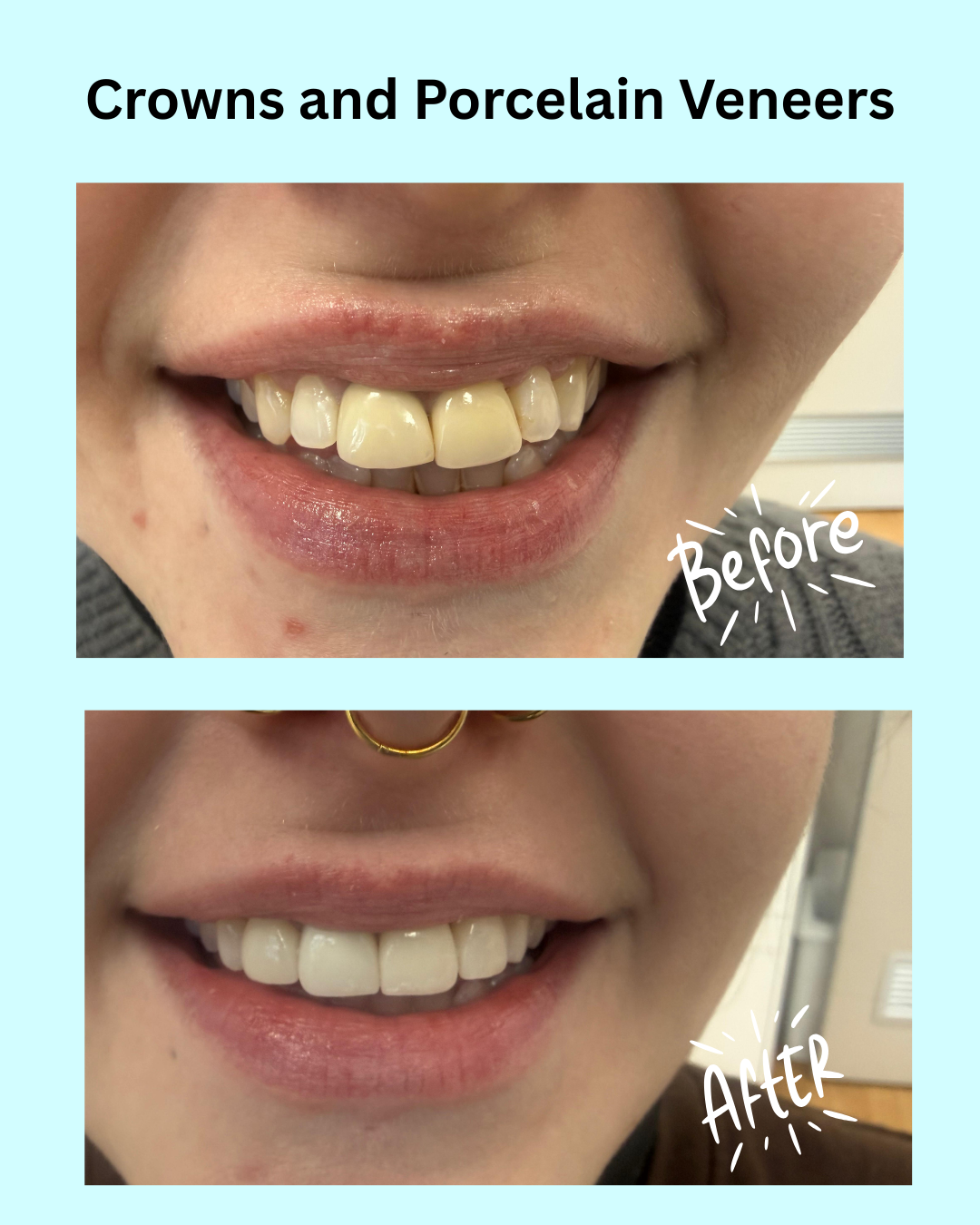 Crowns and Porcelain Veneers